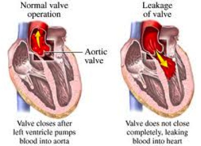 Aortic Regurgitation Cor Medical Group