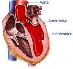 Aortic Stenosis Cormedicalgroup Com