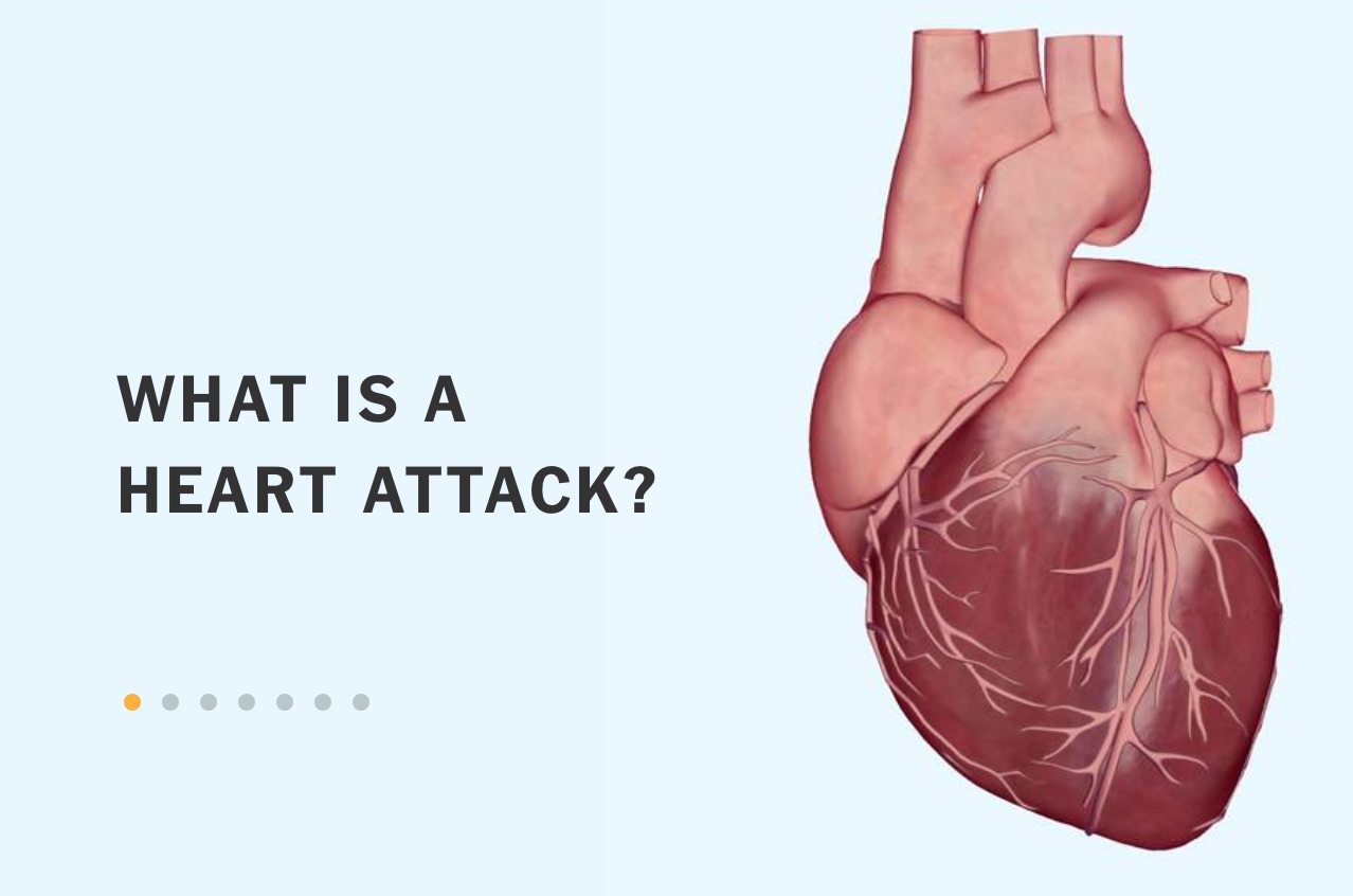 A heart attack (myocardial infarction) occurs when the blood supply to part  of heart muscle seriously decreases or stops, usually due to blockage in a  coronary artery