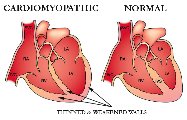 dilated-cardiomyopathy-diagram - COR Medical Group