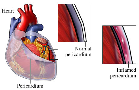 Pericarditis | CORMedicalGroup.com